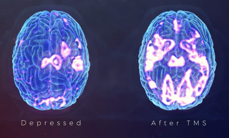Brain scan after TMS treatment