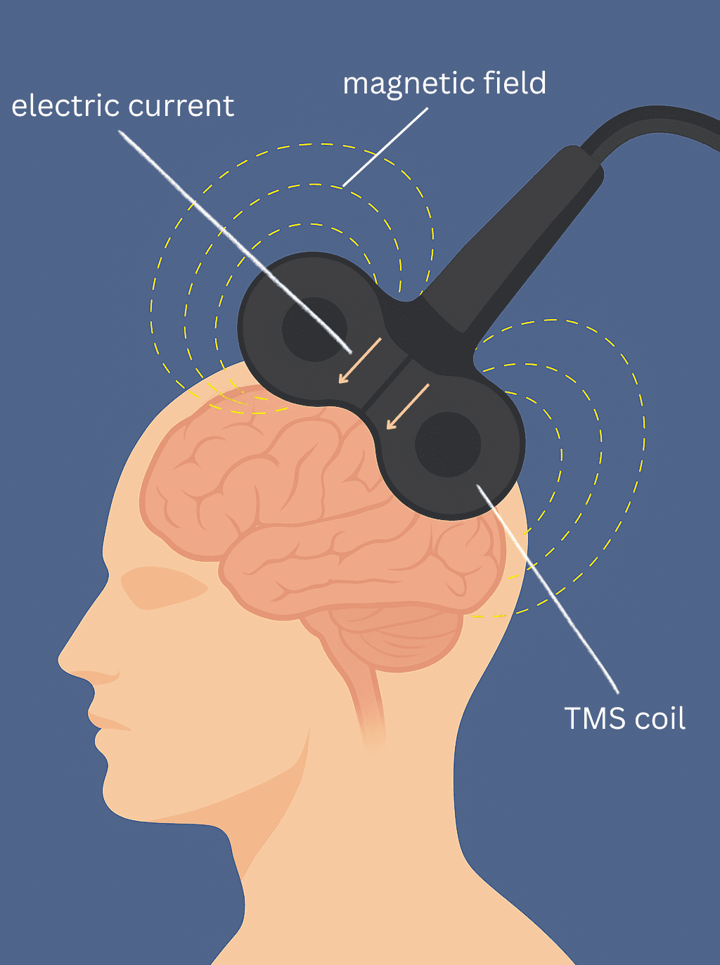 How Brain TMS Works